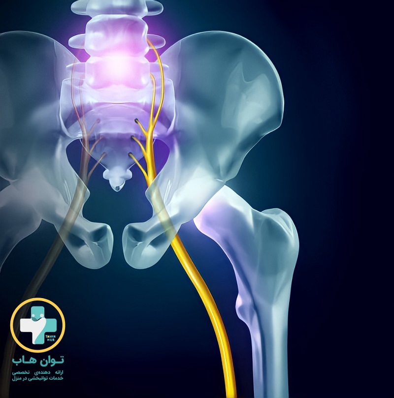 فیزیوتراپی برای سیاتیک 1 فیزیوتراپی برای سیاتیک 1