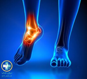 فیزیوتراپی برای مچ پا