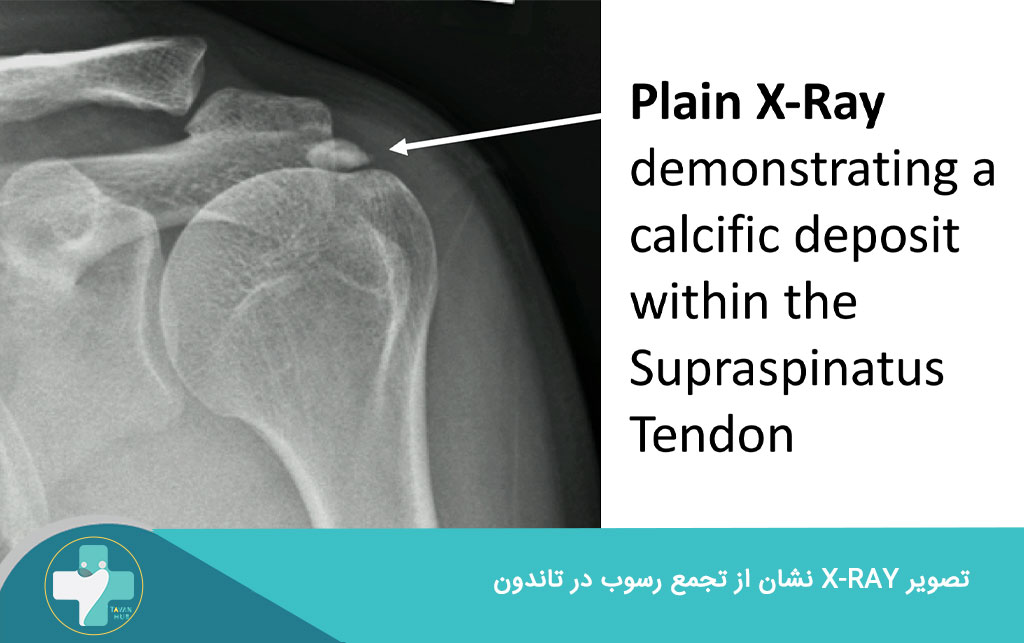 رسوب کلسیم در تاندون ها 