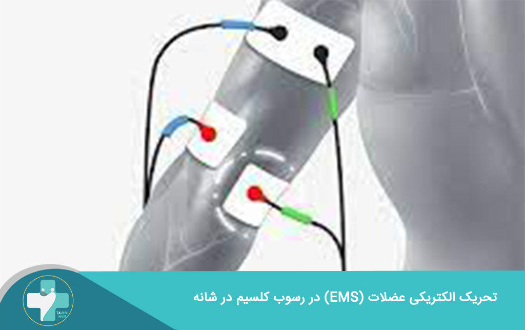 تحریک الکتریکی عضلات برای درمان رسوب کلسیم در شانه