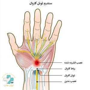 سندرم تونل کارپال