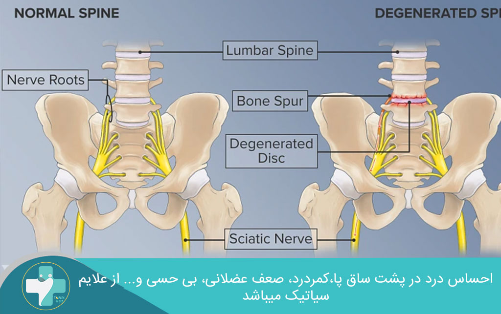 علایم درد سیاتیک 