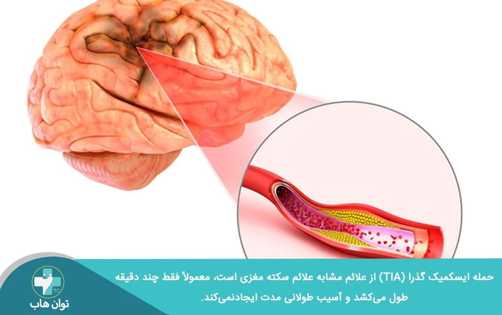 حمله ایسکمیک گذرا (TIA) علائم مشابه علائم سکته مغزی دارد