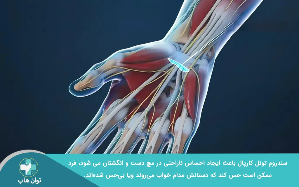 عکس سندروم تونل کارپال که باعث حس درد در دست بیمار می شود.