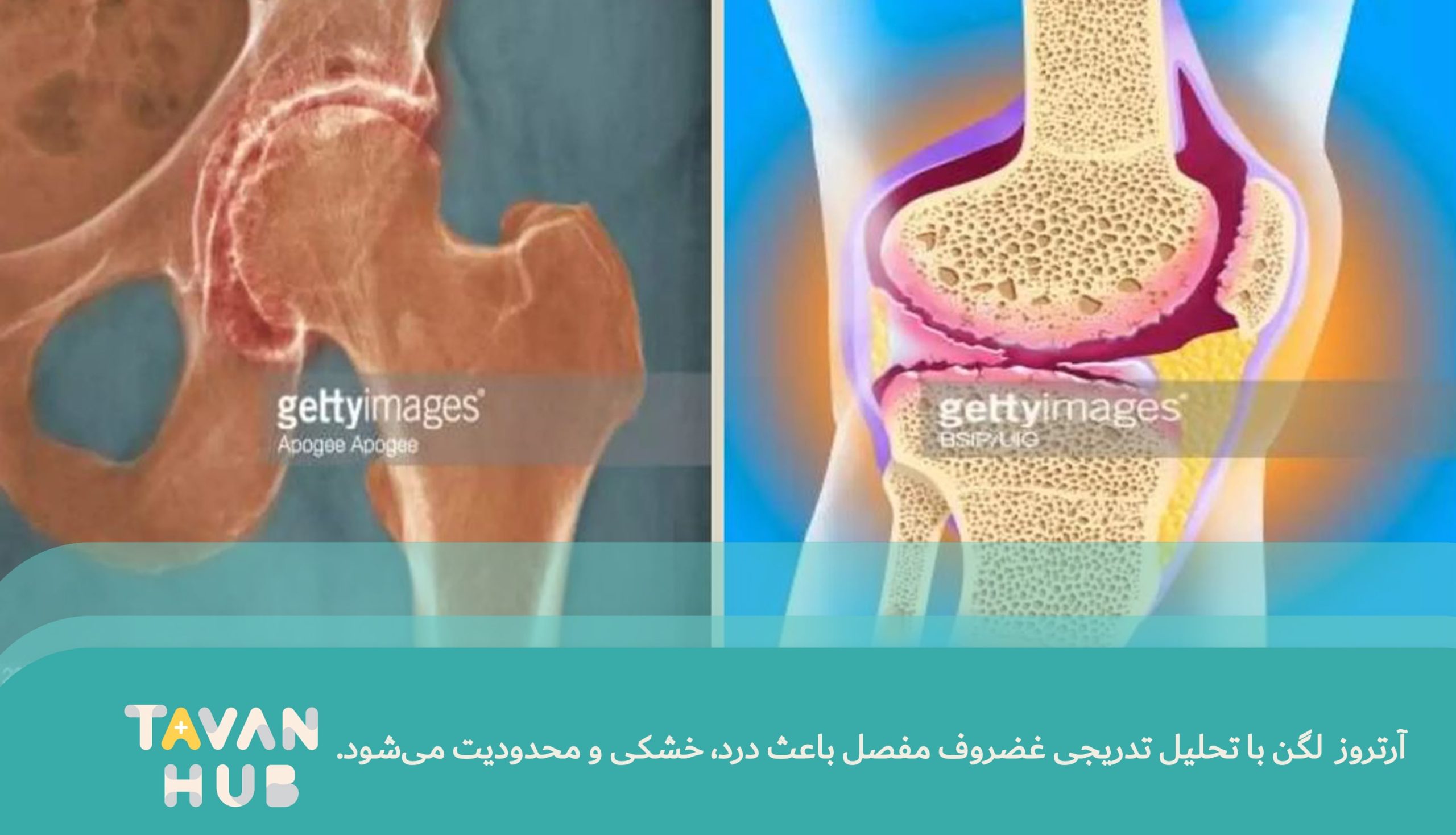 آرتروز لگن چیست؟ علائم، درمان و تمرینات مؤثر کاردرمانی در منزل 3 آرتروز لگن باعث تحلیل تدریجی غضروف مفاصل می شود.