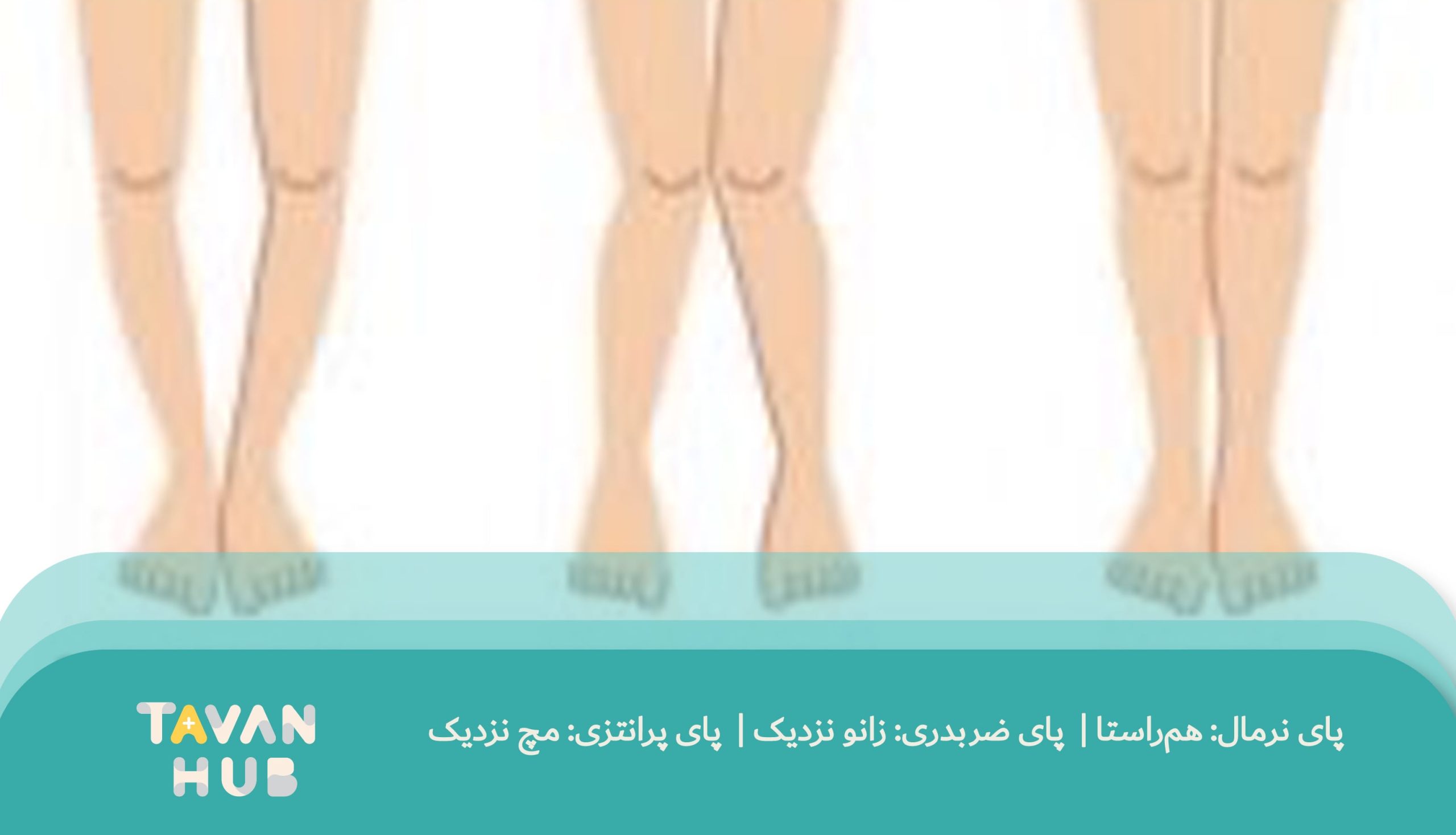 پای پرانتزی و ضربدری در انحراف زانو 