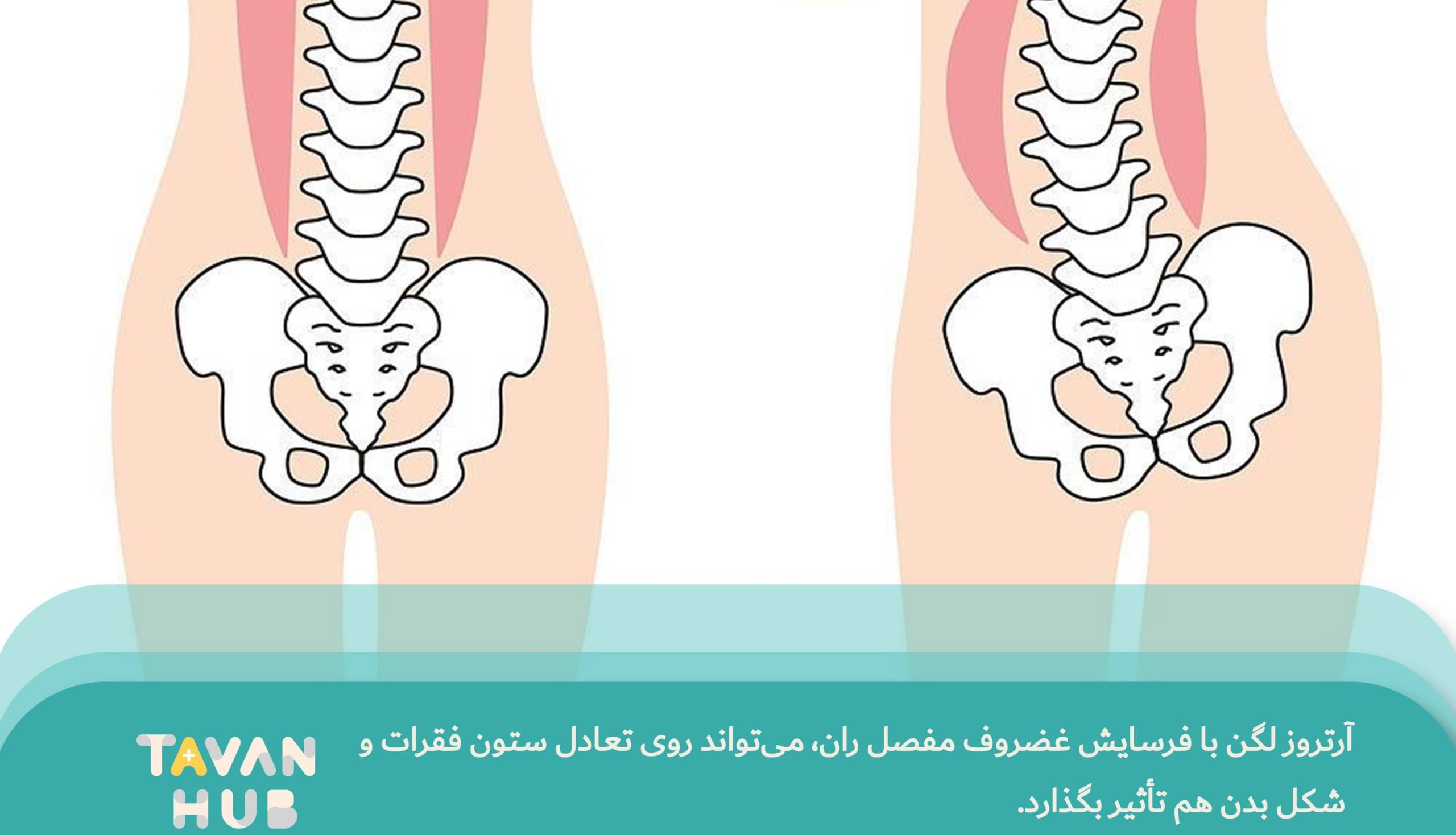 آرتروز لگن چیست؟ علائم، درمان و تمرینات مؤثر کاردرمانی در منزل 1 علائم آرتروز لگن